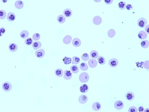 A micrograph shows red blood cells infected by the malaria parasite Plasmodium falciparum. A micrograph shows red blood cells infected by the malaria parasite Plasmodium falciparum.