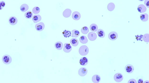 A micrograph shows red blood cells infected by the malaria parasite Plasmodium falciparum. (AP)