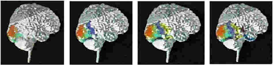 A PET image of a migraine as it develops in the brain of a patient. A PET image of a migraine as it develops in the brain of a patient.