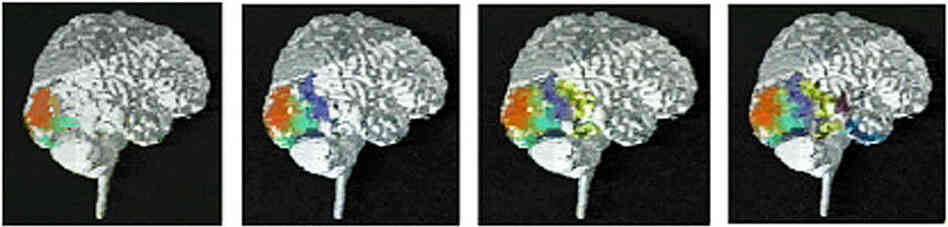 A PET image of a migraine as it develops in the brain of a patient. A PET image of a migraine as it develops in the brain of a patient.