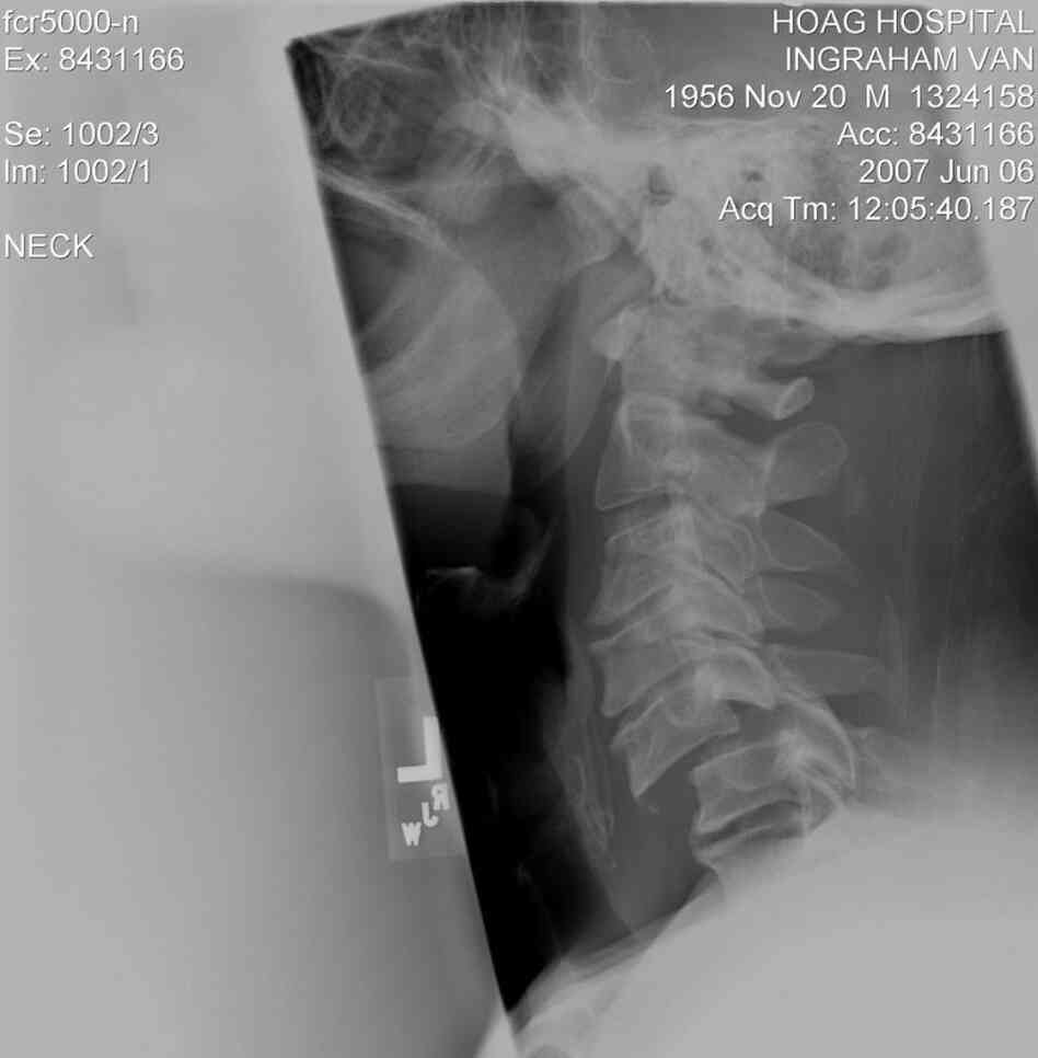 An X-ray of Van Ingraham's neck shows a severe spinal break. Two medical experts say the injury likely came from a headlock. An X-ray of Van Ingraham's neck shows a severe spinal break. Two medical experts say the injury likely came from a headlock.