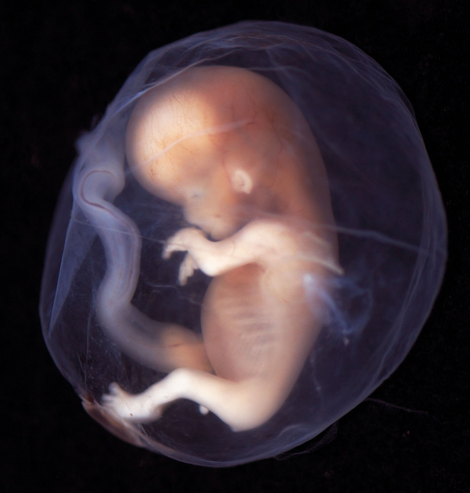 Fotos de fetos de 12 semanas abortados 20 Fotos de fetos de 12 semanas abortados 95