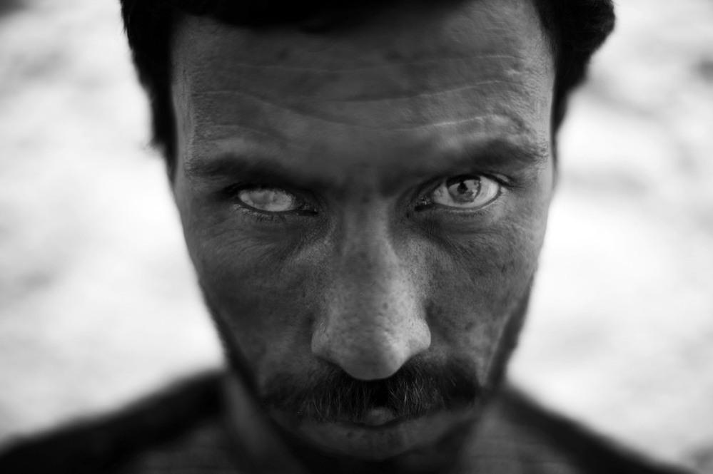 Manullah Ahmadzai, 27, lost the sight in his right eye while serving as a front-line soldier in the Afghan military. Ahmadzai is one of many soldiers who have been severely injured and say promised government benefits don't always arrive.