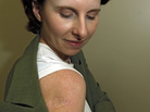 Jodi Duke, a 35-year-old melanoma survivor living in Aurora, Colo., shows the scar left on her arm from melanoma. She used tanning beds as a teen and advocated for a bill to regulate tanning in the state that failed in 2007. Jodi Duke, a 35-year-old melanoma survivor living in Aurora, Colo., shows the scar left on her arm from melanoma. She used tanning beds as a teen and advocated for a bill to regulate tanning in the state that failed in 2007.