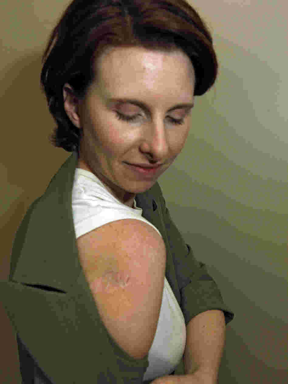 Jodi Duke, a 35-year-old melanoma survivor living in Aurora, Colo., shows the scar left on her arm from melanoma. She used tanning beds as a teen and advocated for a bill to regulate tanning in the state that failed in 2007. Jodi Duke, a 35-year-old melanoma survivor living in Aurora, Colo., shows the scar left on her arm from melanoma. She used tanning beds as a teen and advocated for a bill to regulate tanning in the state that failed in 2007.