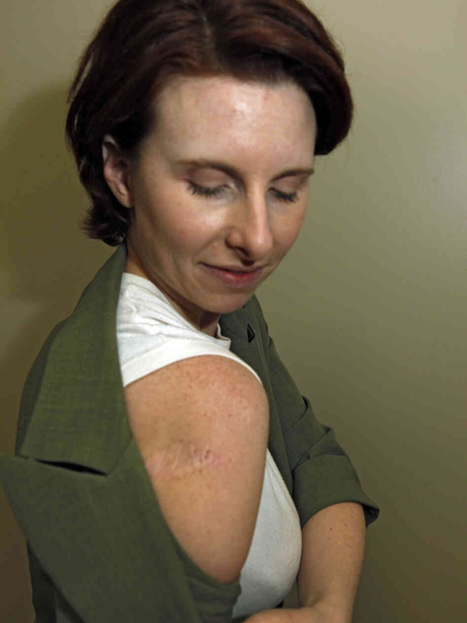 Jodi Duke, a 35-year-old melanoma survivor living in Aurora, Colo., shows the scar left on her arm from melanoma. She used tanning beds as a teen and advocated for a bill to regulate tanning in the state that failed in 2007. Jodi Duke, a 35-year-old melanoma survivor living in Aurora, Colo., shows the scar left on her arm from melanoma. She used tanning beds as a teen and advocated for a bill to regulate tanning in the state that failed in 2007.