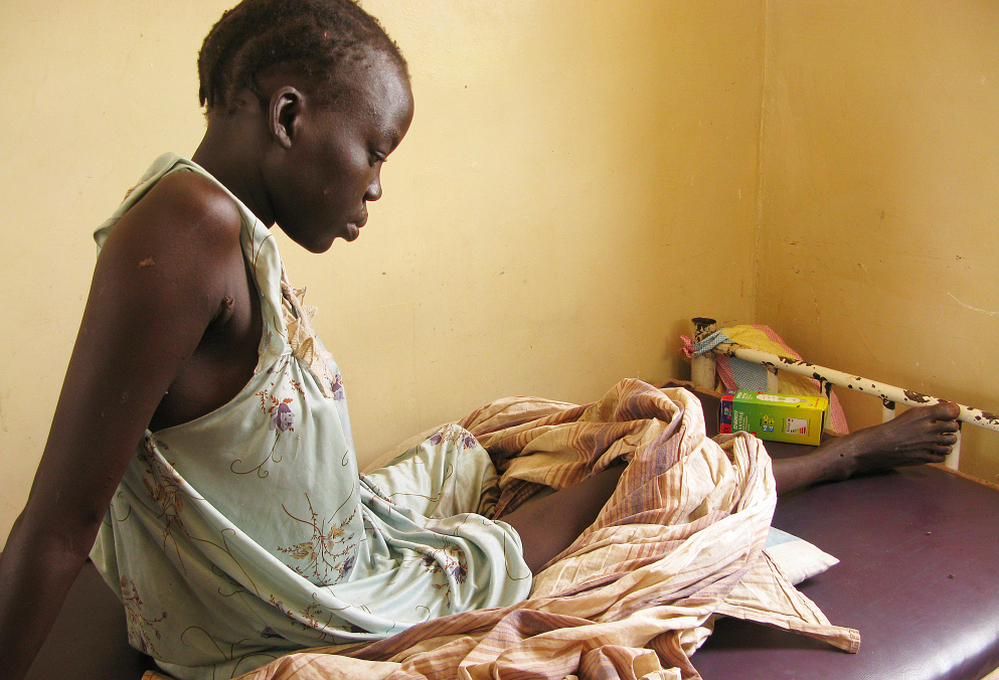 Nyachieng Nguot Teng, 25, lost her left leg and her 7-month-old son suffered a fractured leg when a Sudanese bomb fell on her hut in Lalat, South Sudan, on May 5. The United Nations is trying to prevent the recent fighting between the two Sudans from escalating into full-scale war.