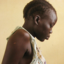 Nyachieng Nguot Teng, 25, lost her left leg and her 7-month-old son suffered a fractured leg when a Sudanese bomb fell on her hut in Lalat, South Sudan, on May 5. The United Nations is trying to prevent the recent fighting between the two Sudans from escalating into full-scale war. Nyachieng Nguot Teng, 25, lost her left leg and her 7-month-old son suffered a fractured leg when a Sudanese bomb fell on her hut in Lalat, South Sudan, on May 5. The United Nations is trying to prevent the recent fighting between the two Sudans from escalating into full-scale war.