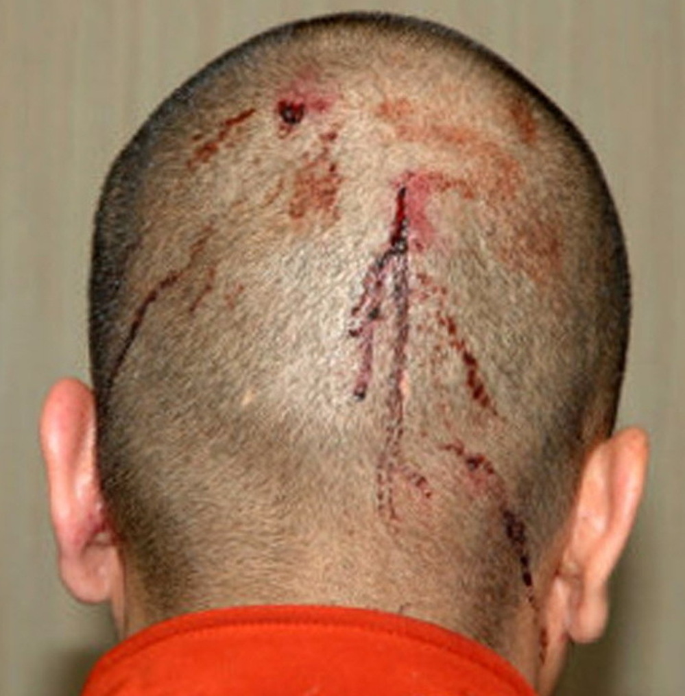 A photograph of George Zimmerman's head taken after the Feb. 26 shooting death of Trayvon Martin. It shows blood from injuries he Zimmerman says he received during their encounter.