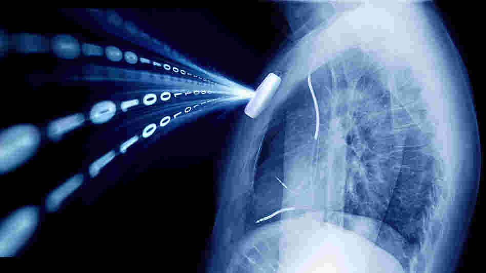 Hugo Campos' implantable cardioverter-defibrillator was a mystery to him. So he decided to ask his doctor for access to the data. He made this image with one of his own X-rays. Hugo Campos' implantable cardioverter-defibrillator was a mystery to him. So he decided to ask his doctor for access to the data. He made this image with one of his own X-rays.