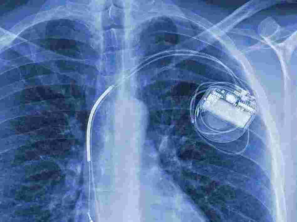 A few years ago, Hugo Campos was diagnosed with a heart condition. Then he received an implantable cardioverter-defibrillator, or ICD, shown here in his X-ray.