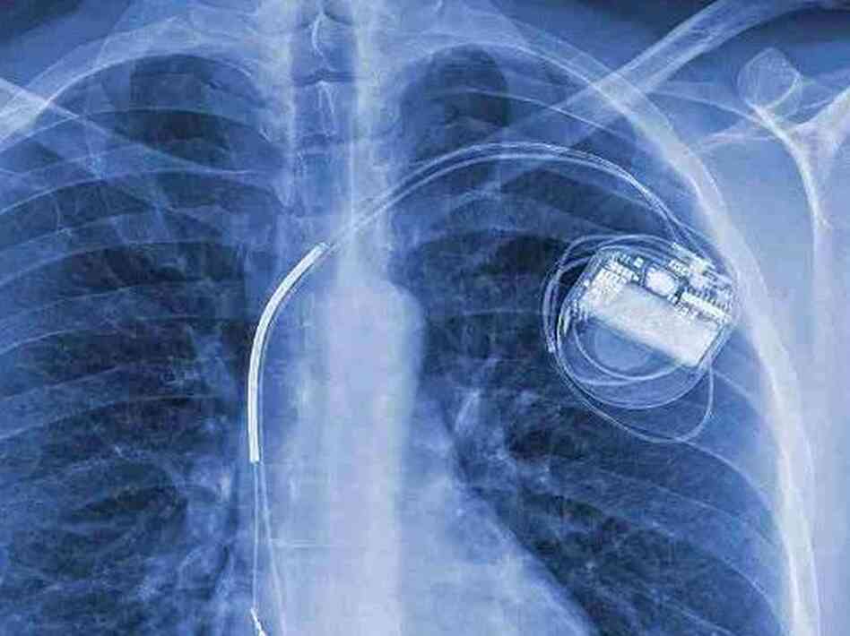 A few years ago, Hugo Campos was diagnosed with a heart condition. Then he received an implantable cardioverter-defibrillator, or ICD, shown here in his X-ray.