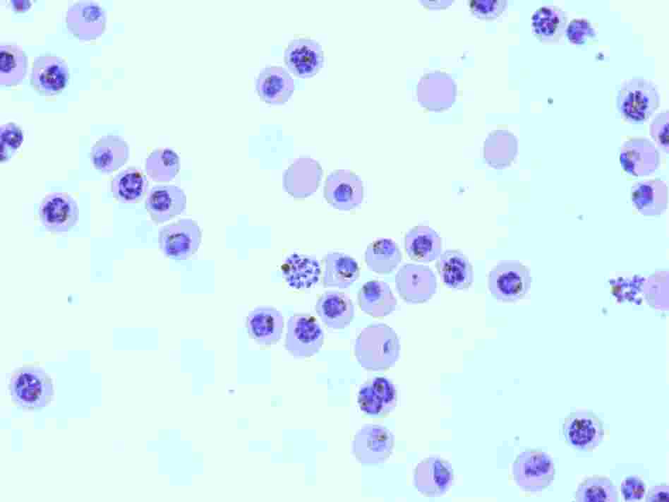 A micrograph shows red blood cells infected by the malaria parasite Plasmodium falciparum. A micrograph shows red blood cells infected by the malaria parasite Plasmodium falciparum.