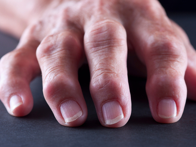 Rheumatoid arthritis is an autoimmune disease that can cause painful inflammation in the fingers and other joints.