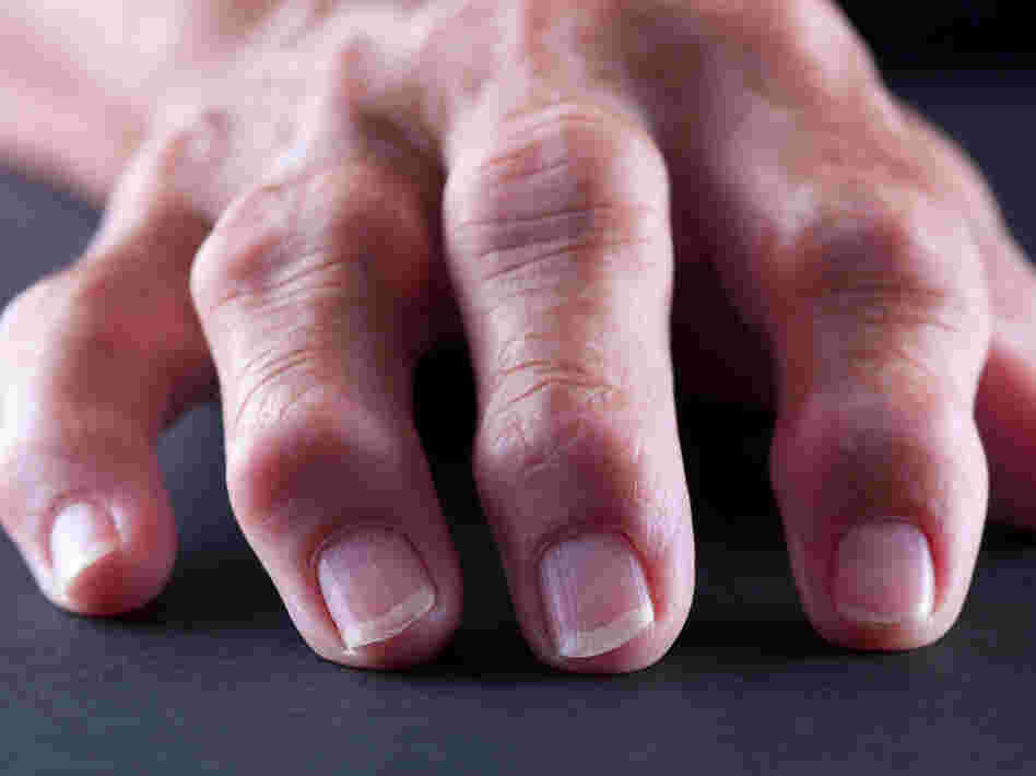 Rheumatoid arthritis is an autoimmune disease that can cause painful inflammation in the fingers and other joints.