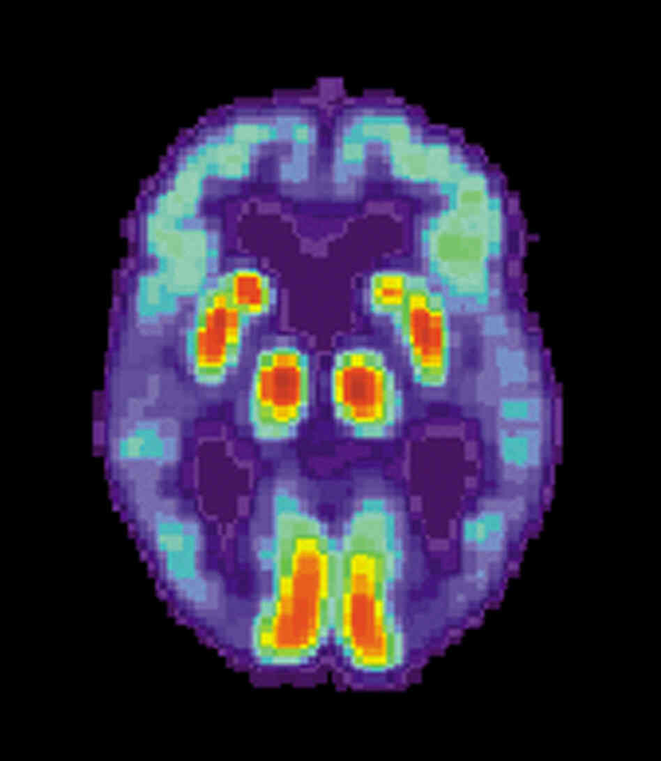 A PET scan of the brain of a person with Alzheimer's disease.
