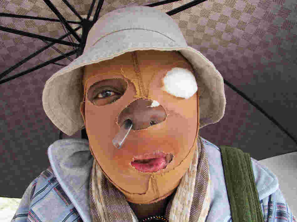 Consuelo Cordoba's partner threw acid at her a decade ago. The 51-year-old Colombian has undergone multiple surgeries and is unable to find work. This year, about 100 cases of acid attacks — mostly against women — have already been reported in Colombia. Consuelo Cordoba's partner threw acid at her a decade ago. The 51-year-old Colombian has undergone multiple surgeries and is unable to find work. This year, about 100 cases of acid attacks — mostly against women — have already been reported in Colombia.