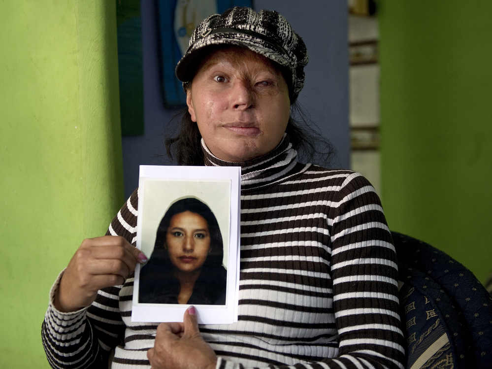 Maria Cuervo, 41, poses at her home in Bogota March 5 with a photo of herself before a stranger threw acid at her face in 2004.