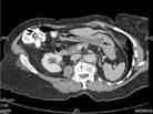 A CT scan showing a pen in a woman's stomach. A CT scan showing a pen in a woman's stomach.