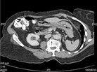 A CT scan showing a pen in a woman's stomach. A CT scan showing a pen in a woman's stomach.