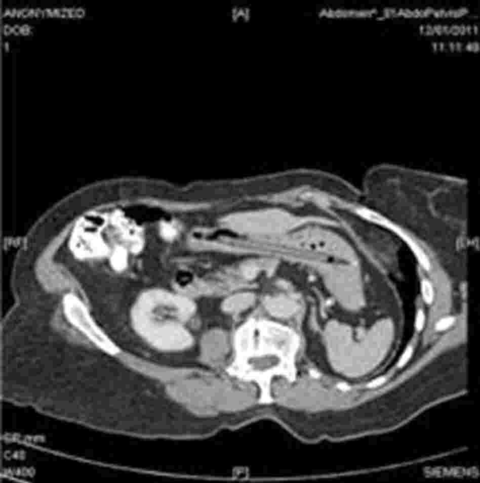 A CT scan showing a pen in a woman's stomach.