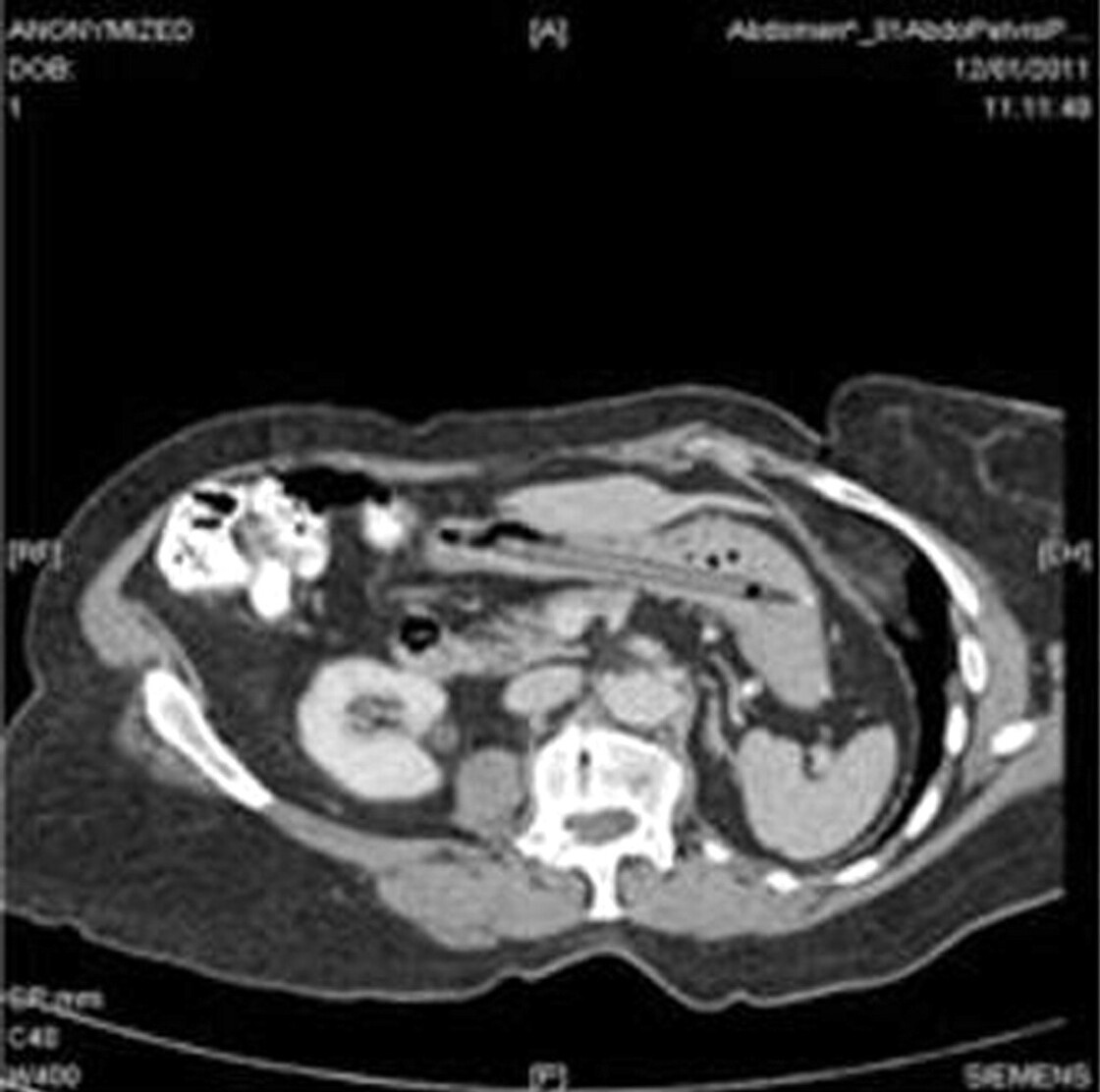 A CT scan showing a pen in a woman's stomach.