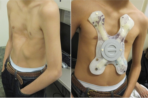 Justin Rosales, 14, had a powerful magnet implanted in his chest that snaps onto another one inside a brace, shown on the right. Over the next two years, doctors hope the magnets will gradually correct his sunken chest.