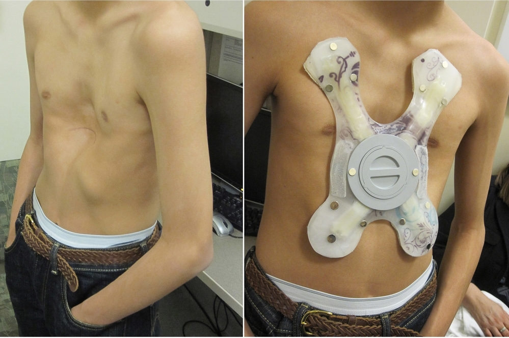 Justin Rosales, 14, had a powerful magnet implanted in his chest that snaps onto another one inside a brace, shown on the right. Over the next two years, doctors hope the magnets will gradually correct his sunken chest.