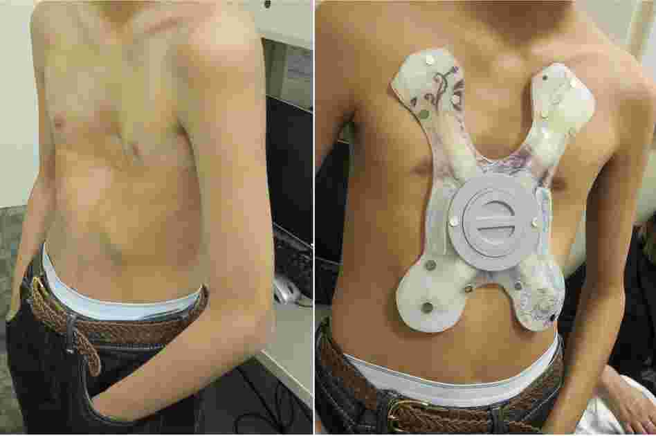 Justin Rosales, 14, had a powerful magnet implanted in his chest that snaps onto another one inside a brace, shown on the right. Over the next two years, doctors hope the magnets will gradually correct his sunken chest.