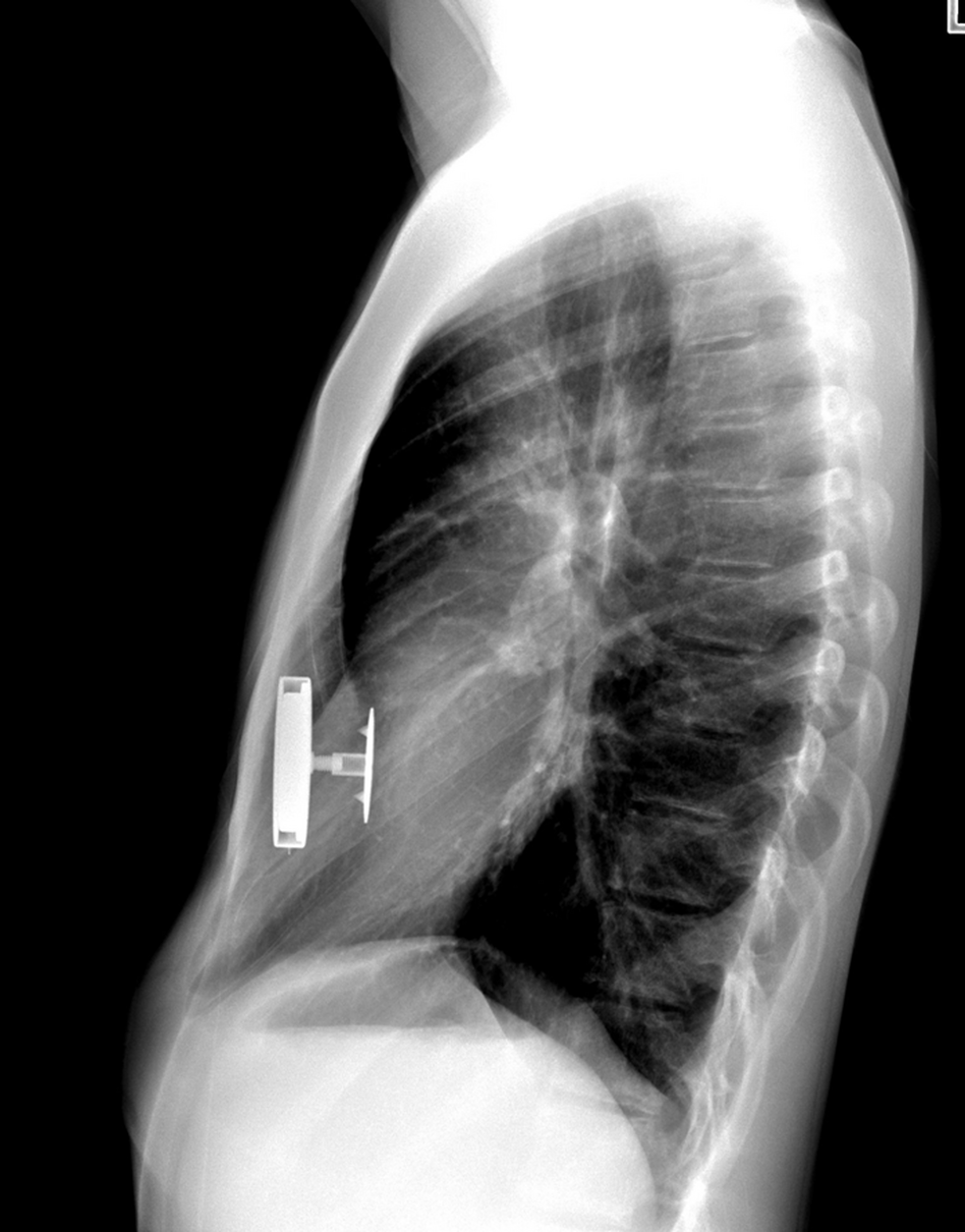 An X-ray of Justin Rosales' torso shows the magnet implanted inside his chest.
