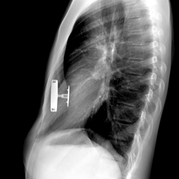 An X-ray of Justin Rosales' torso shows the magnet implanted inside his chest.