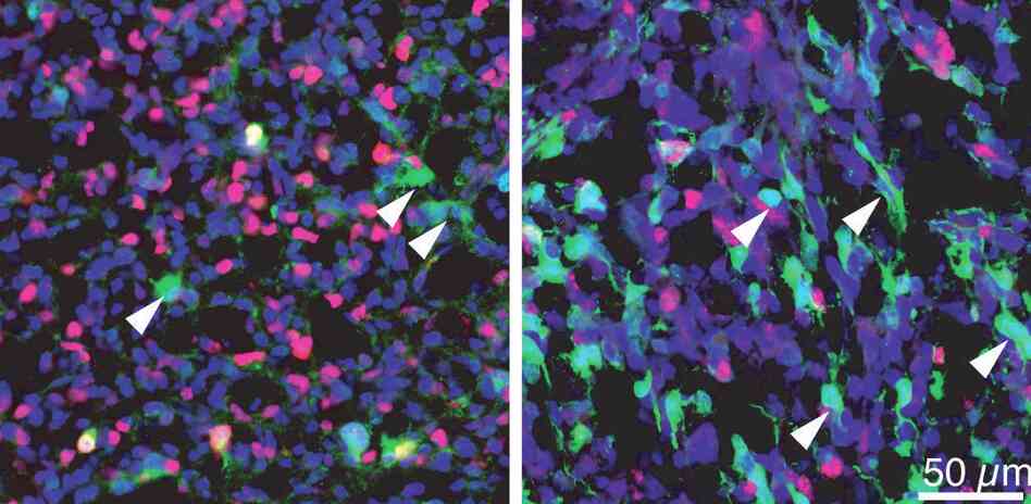 The white arrows in these two tumor samples point to a subset of tumor cells that are in a resting state.