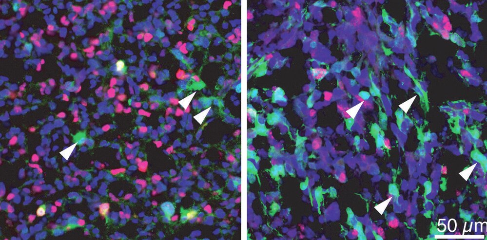 The white arrows in these two tumor samples point to a subset of tumor cells that are in a resting state.