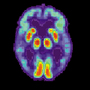 A PET scan of the brain of a person with Alzheimer's disease. A PET scan of the brain of a person with Alzheimer's disease.