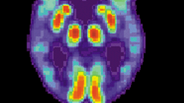 A PET scan of the brain of a person with Alzheimer's disease. (via Wikimedia Commons)
