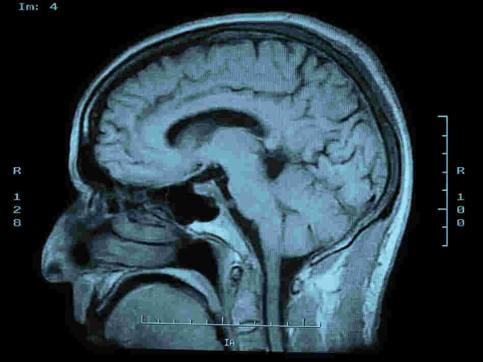 mri brain scan