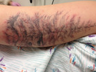 Along with a tattoo, this person got an infection. Along with a tattoo, this person got an infection.