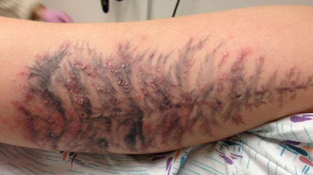 Along with a tattoo, this person got an infection.