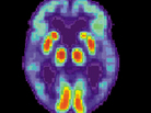 A PET scan of the brain of a person with Alzheimer's disease. A PET scan of the brain of a person with Alzheimer's disease.