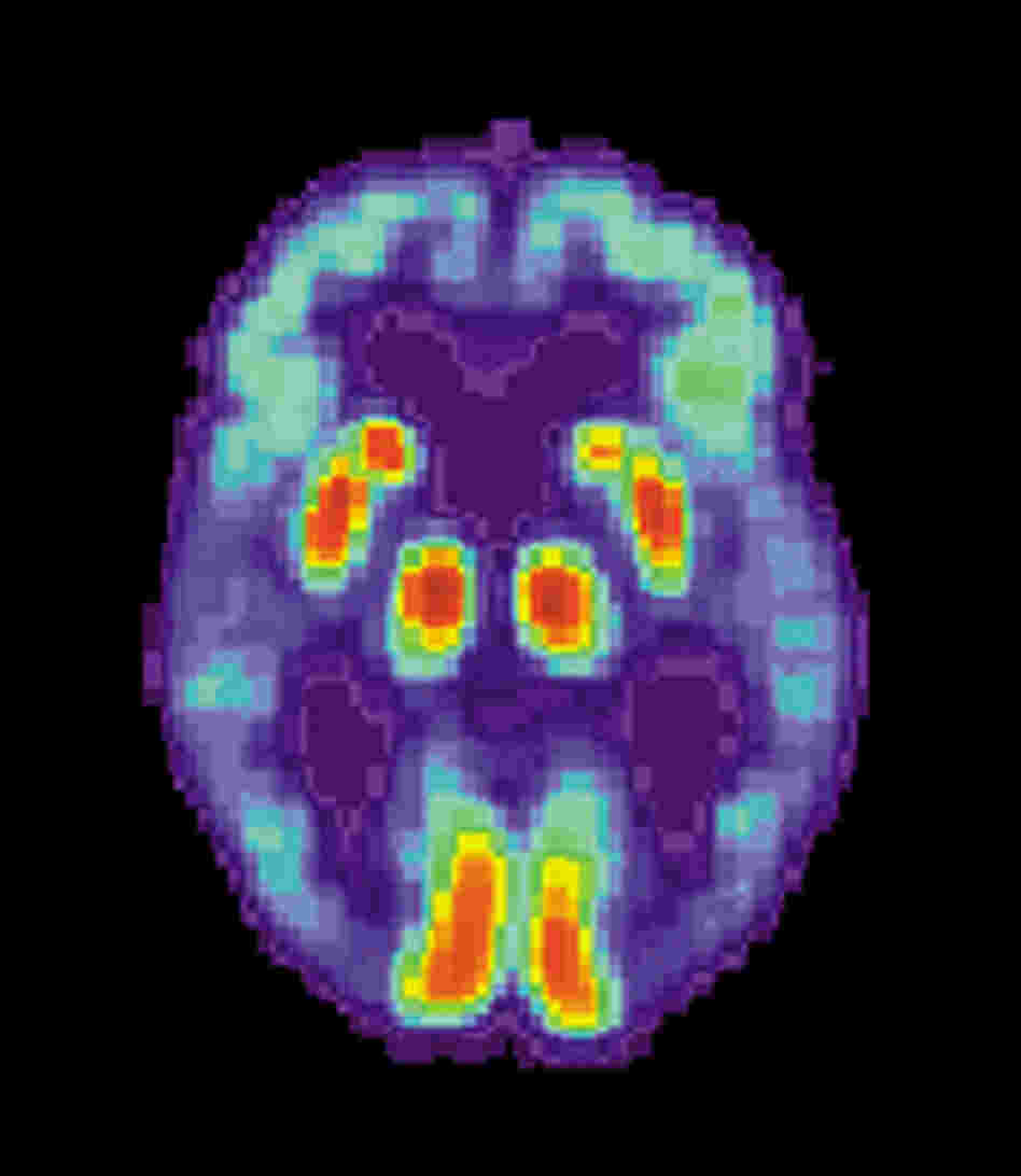 A PET scan of the brain of a person with Alzheimer's disease.