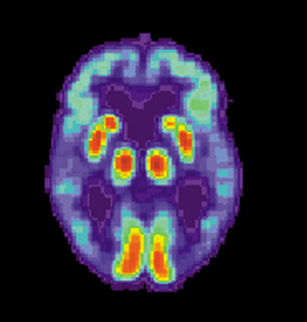 A PET scan of the brain of a person with Alzheimer's disease.