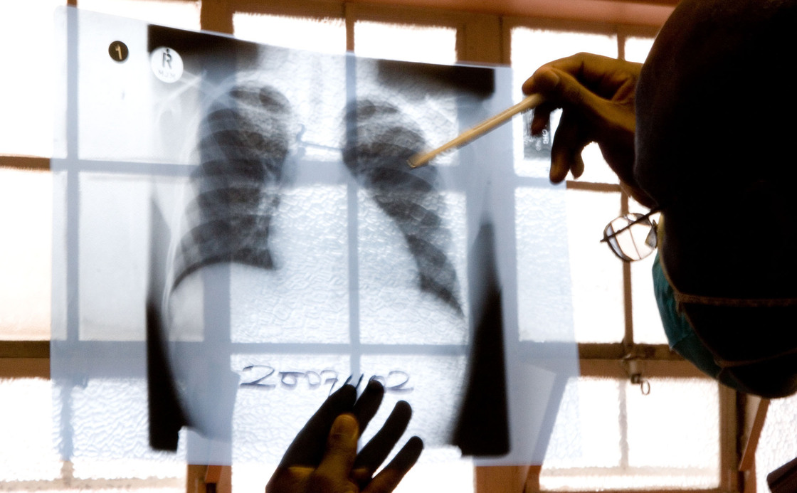 A doctor examines chest X-rays at a tuberculosis clinic in Gugulethu, Cape Town, South Africa in late 2007. The number of TB cases that don't respond to both first- and second-line medications is rising worldwide.