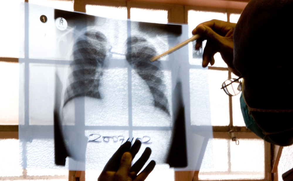 A doctor examines chest X-rays at a tuberculosis clinic in Gugulethu, Cape Town, South Africa in late 2007. The number of TB cases that don't respond to both first- and second-line medications is rising worldwide.