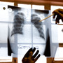A doctor examines chest X-rays at a tuberculosis clinic in Gugulethu, Cape Town, South Africa in late 2007. The number of TB cases that don't respond to both first- and second-line medications is rising worldwide. A doctor examines chest X-rays at a tuberculosis clinic in Gugulethu, Cape Town, South Africa in late 2007. The number of TB cases that don't respond to both first- and second-line medications is rising worldwide.