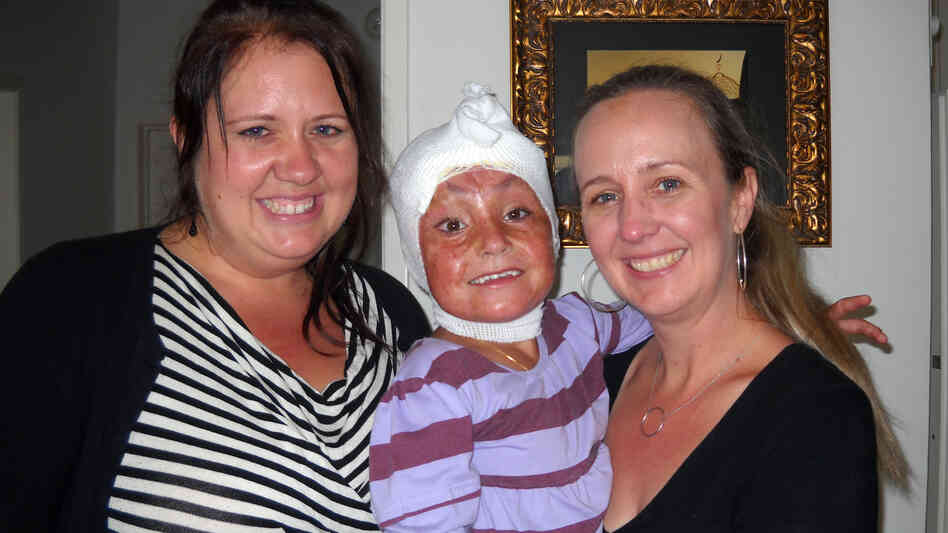 Arefa with her host family, sisters Jami Valentine (left) and Staci Freeman. Doctors in the U.S. have been treating Arefa's third-degree burns, and also performed skin-graft surgery for the top of her head. Each morning still requires a fresh dressing. Arefa with her host family, sisters Jami Valentine (left) and Staci Freeman. Doctors in the U.S. have been treating Arefa's third-degree burns, and also performed skin-graft surgery for the top of her head. Each morning still requires a fresh dressing.