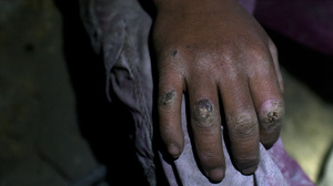 A 17-year-old miner's hand, already battered from back-breaking work in Cerro Rico in Potosi, Bolivia, on Aug. 17.