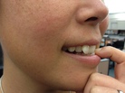 Pathological nail biting may be a form of grooming on steroids, but it also makes the biter feel good, unlike fear-driven OCD. Pathological nail biting may be a form of grooming on steroids, but it also makes the biter feel good, unlike fear-driven OCD.