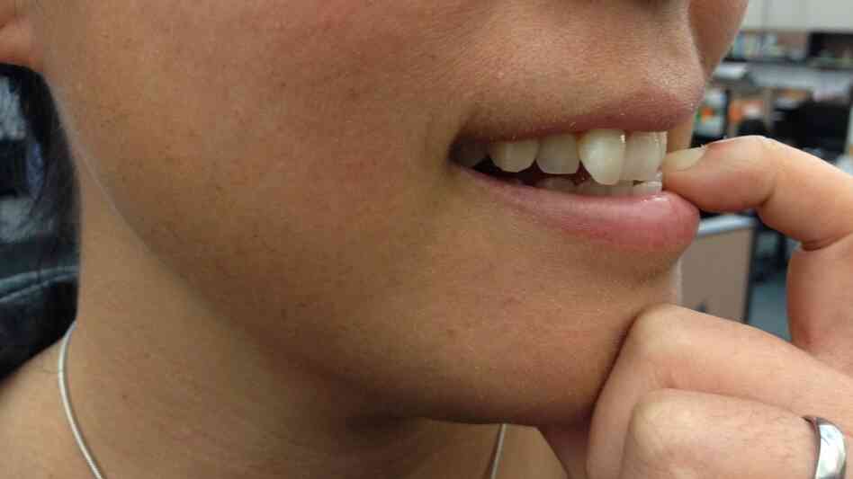Pathological nail biting may be a form of grooming on steroids, but it also makes the biter feel good, unlike fear-driven OCD.