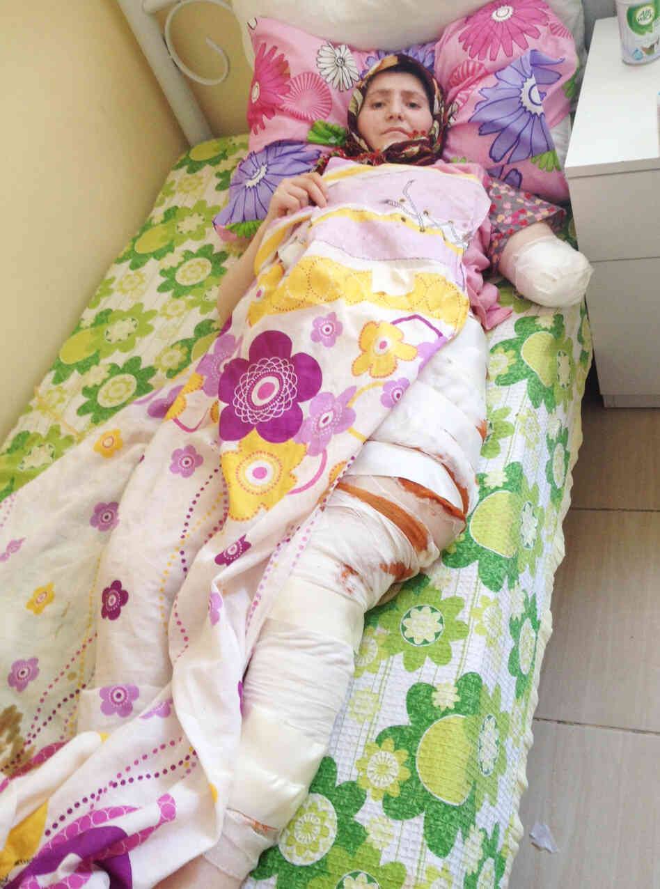 This 24-year-old Syrian woman from Homs was evacuated through the sewer system — which resulted in badly infected wounds — to a rehabilitation center in southern Turkey. She has had several surgeries to her abdomen and leg; her left arm was amputated.