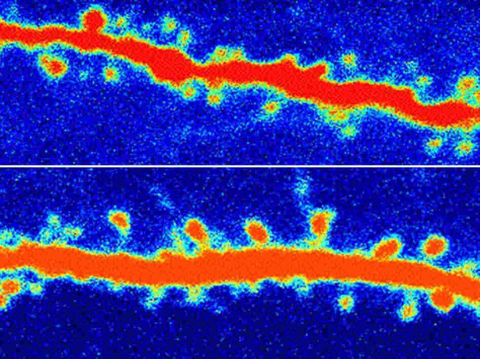 A rat neuron before (top) and after (bottom) ketamine treatment.  The increased number of orange nodes are restored connections in the rat's brain.